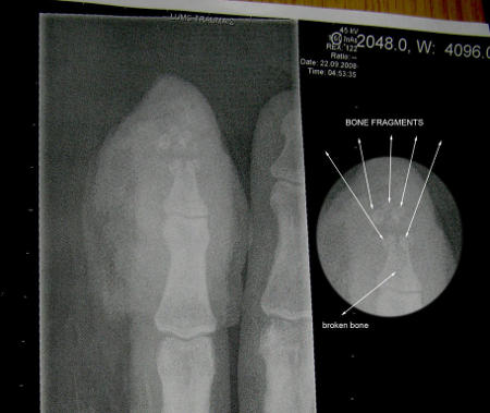 Röntgenkuva sormesta onnettomuuden jälkeen. Murtunut sormenpää näkyvissä